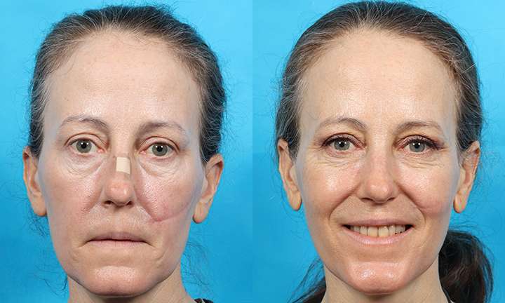 Scar Revision Before and After Photo by Dr. Cleveland in West Palm Beach Florida