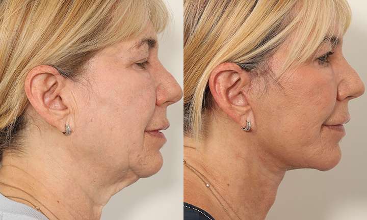 Facelift Before and After Photo by Dr. Cleveland in West Palm Beach Florida