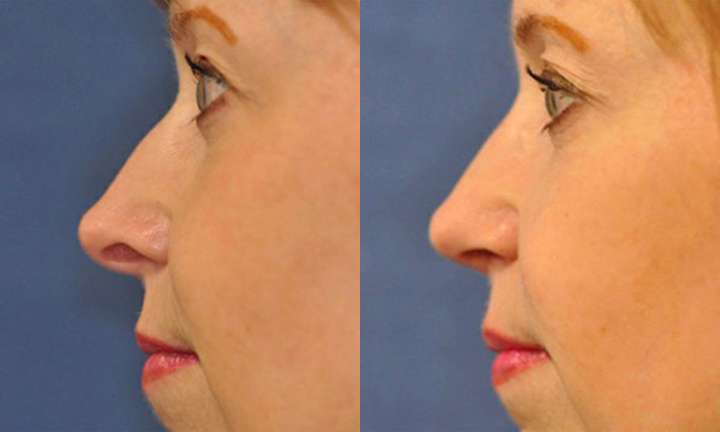 Rhinoplasty Before and After Photo by Dr. Cleveland in West Palm Beach Florida