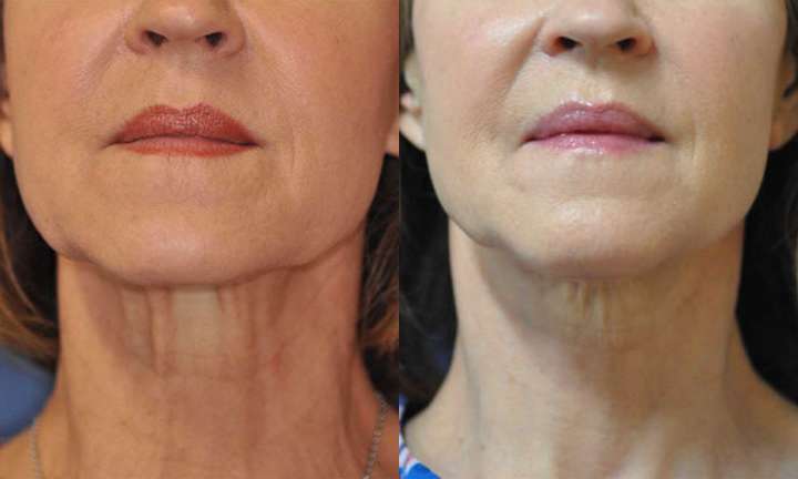 Facelift Before and After Photo by Dr. Cleveland in West Palm Beach Florida