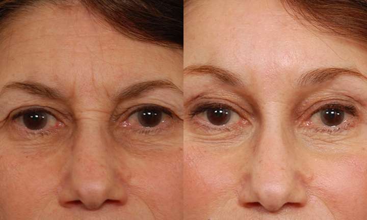 Blepharoplasty Before and After Photo by Dr. Cleveland in West Palm Beach Florida