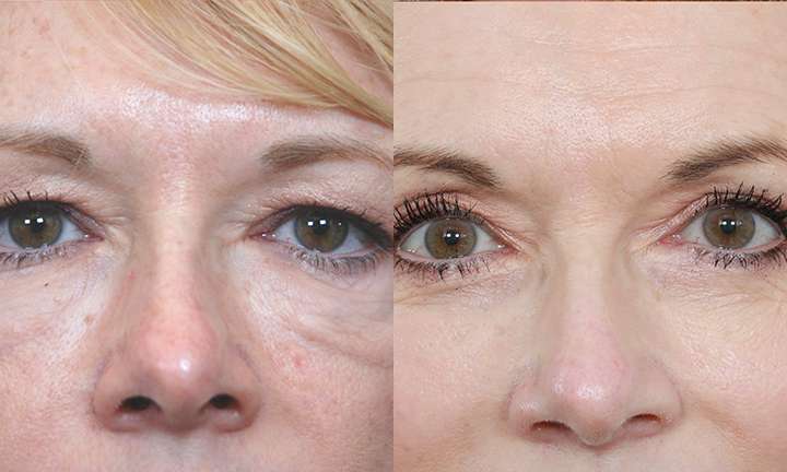 Blepharoplasty Before and After Photo by Dr. Cleveland in West Palm Beach Florida