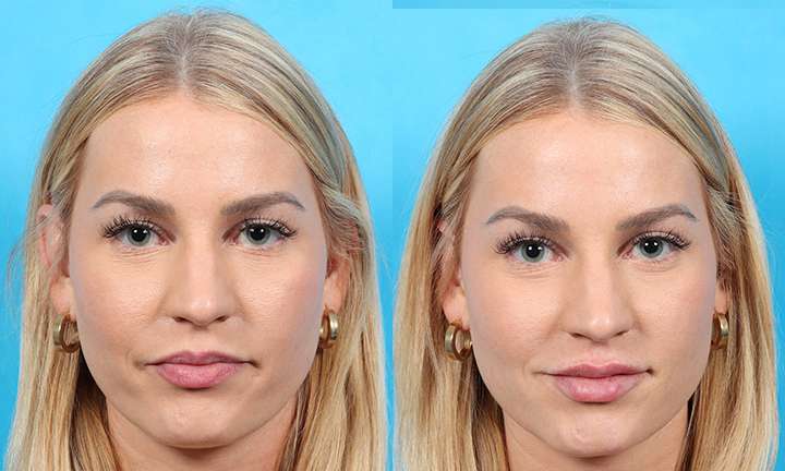 Lip Augmentation Before and After Photo by Dr. Cleveland in West Palm Beach Florida