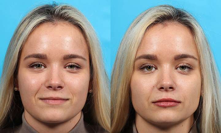 Lip Augmentation Before and After Photo by Dr. Cleveland in West Palm Beach Florida