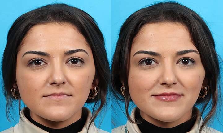 Lip Augmentation Before and After Photo by Dr. Cleveland in West Palm Beach Florida