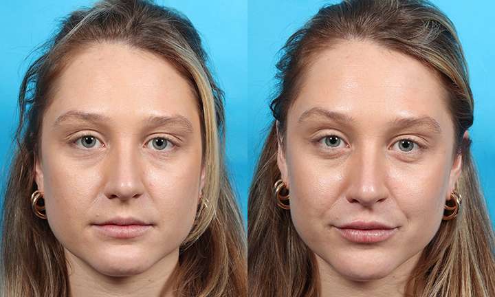 Lip Augmentation Before and After Photo by Dr. Cleveland in West Palm Beach Florida