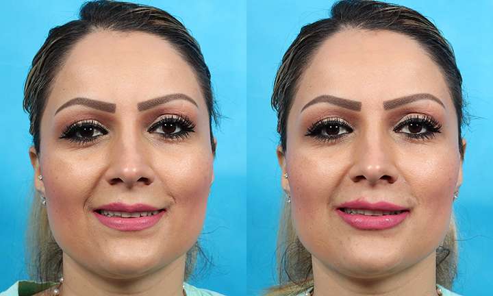 Lip Augmentation Before and After Photo by Dr. Cleveland in West Palm Beach Florida