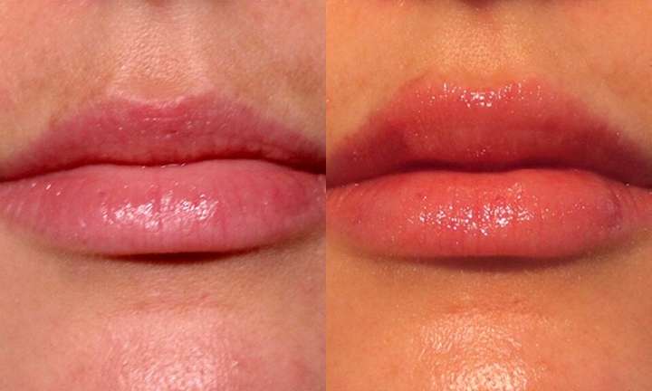 Lip Augmentation Before and After Photo by Dr. Cleveland in West Palm Beach Florida