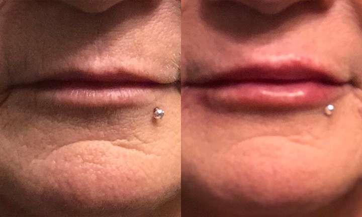 Lip Augmentation Before and After Photo by Dr. Cleveland in West Palm Beach Florida
