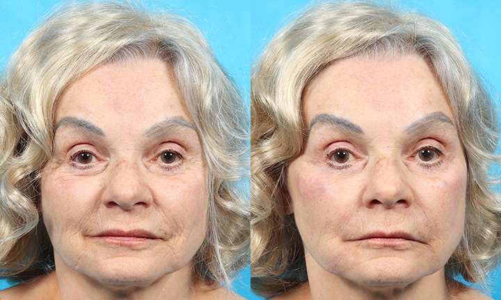 Cheek Augmentation Before and After Photo by Dr. Cleveland in West Palm Beach Florida