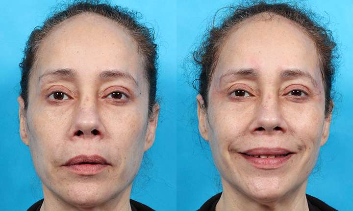 Injectable Fillers Before and After Photo by Dr. Cleveland in West Palm Beach Florida
