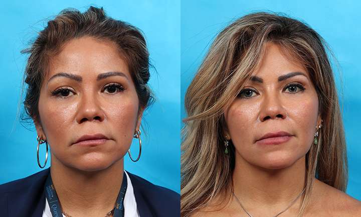 Buccal Fat Removal Before and After Photo by Dr. Cleveland in West Palm Beach Florida
