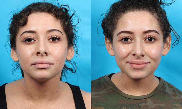 Submental Liposuction Before and After Photo by Dr. Cleveland in West Palm Beach Florida