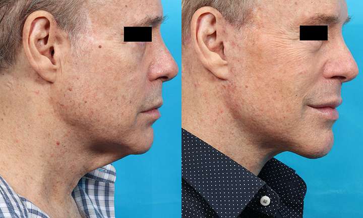 Facelift Before and After Photo by Dr. Cleveland in West Palm Beach Florida