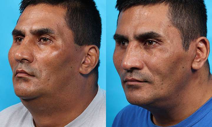 Facelift Before and After Photo by Dr. Cleveland in West Palm Beach Florida