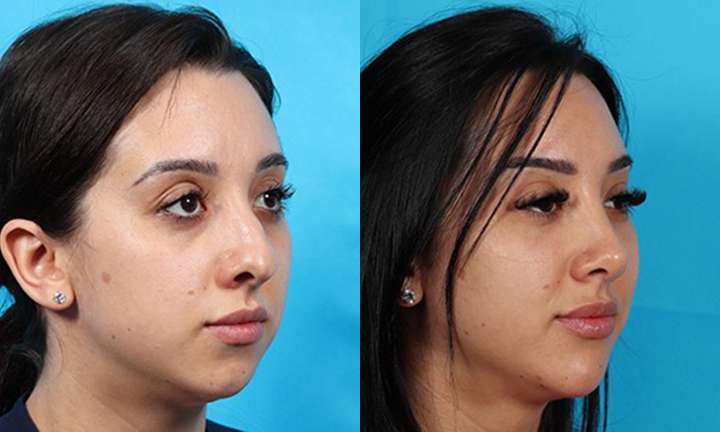 Rhinoplasty Before and After Photo by Dr. Cleveland in West Palm Beach Florida