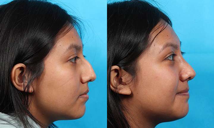 Rhinoplasty Before and After Photo by Dr. Cleveland in West Palm Beach Florida