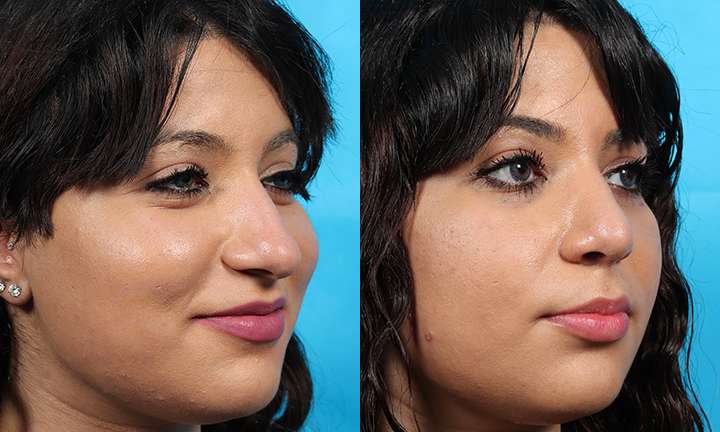 Rhinoplasty Before and After Photo by Dr. Cleveland in West Palm Beach Florida