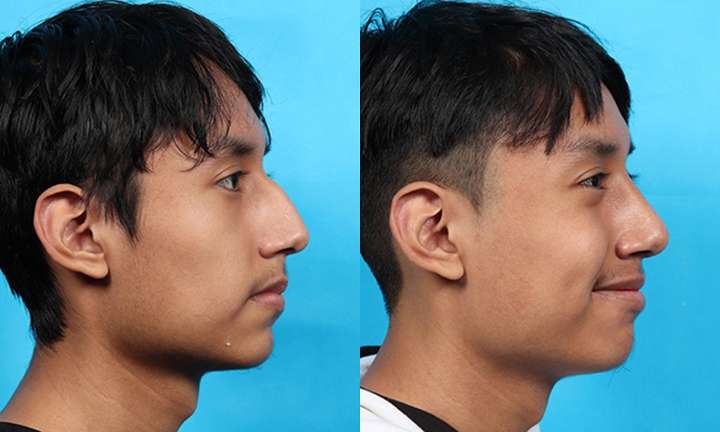 Rhinoplasty Before and After Photo by Dr. Cleveland in West Palm Beach Florida