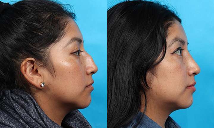 Rhinoplasty Before and After Photo by Dr. Cleveland in West Palm Beach Florida
