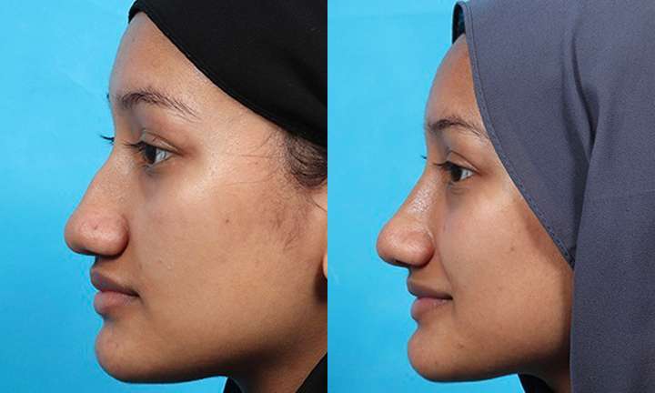 Rhinoplasty Before and After Photo by Dr. Cleveland in West Palm Beach Florida