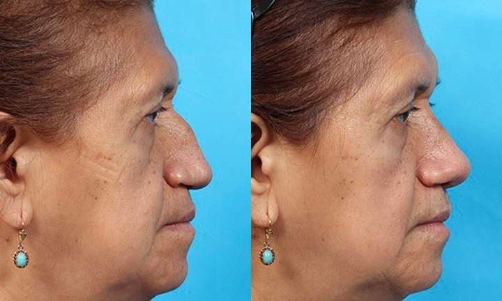 Rhinoplasty Before and After Photo by Dr. Cleveland in West Palm Beach Florida
