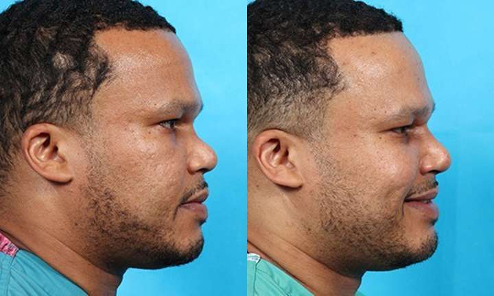 Rhinoplasty Before and After Photo by Dr. Cleveland in West Palm Beach Florida