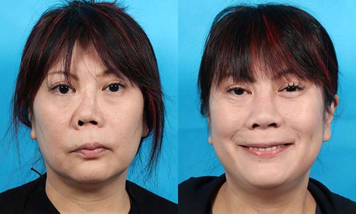 Rhinoplasty Before and After Photo by Dr. Cleveland in West Palm Beach Florida