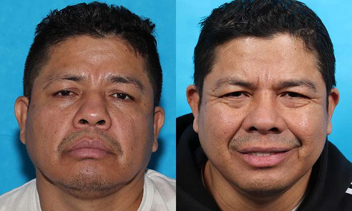 Rhinoplasty Before and After Photo by Dr. Cleveland in West Palm Beach Florida