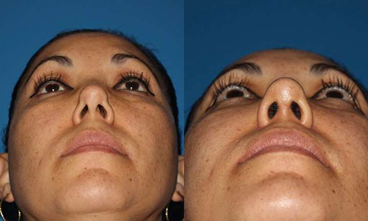 Rhinoplasty Before and After Photo by Dr. Cleveland in West Palm Beach Florida