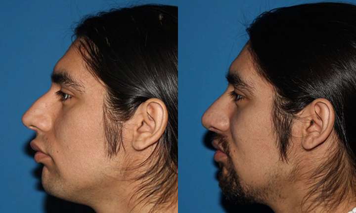 Rhinoplasty Before and After Photo by Dr. Cleveland in West Palm Beach Florida