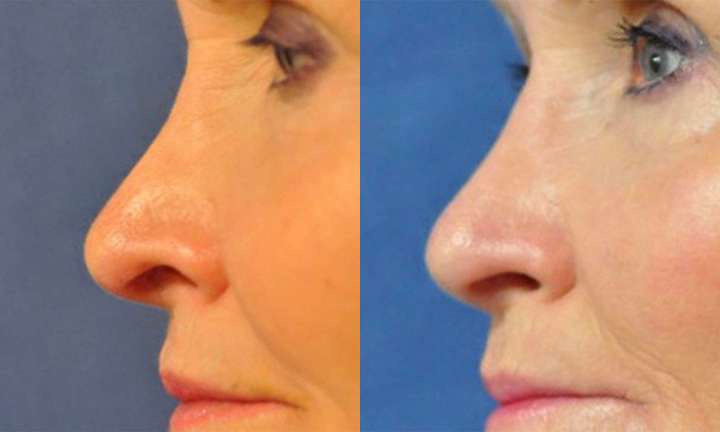 Rhinoplasty Before and After Photo by Dr. Cleveland in West Palm Beach Florida