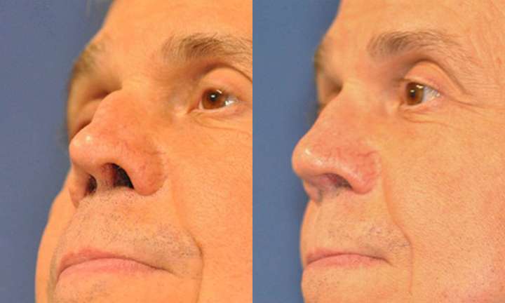 Rhinoplasty Before and After Photo by Dr. Cleveland in West Palm Beach Florida