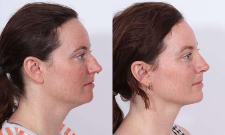 Rhinoplasty Before and After Photo by Dr. Cleveland in West Palm Beach Florida