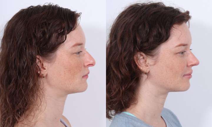 Rhinoplasty Before and After Photo by Dr. Cleveland in West Palm Beach Florida