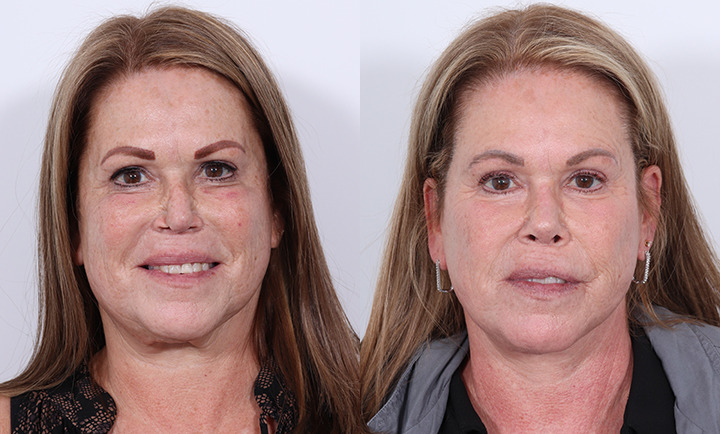 Rhinoplasty Before and After Photo by Dr. Cleveland in West Palm Beach Florida