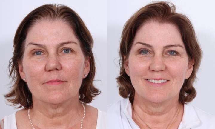 Rhinoplasty Before and After Photo by Dr. Cleveland in West Palm Beach Florida