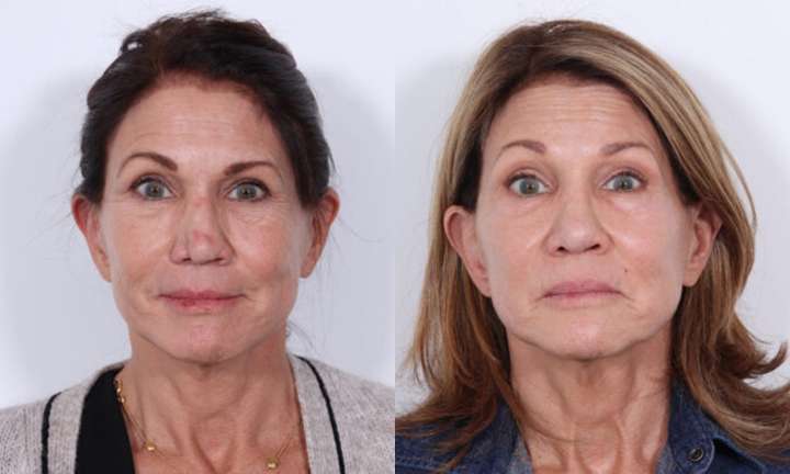 Rhinoplasty Before and After Photo by Dr. Cleveland in West Palm Beach Florida