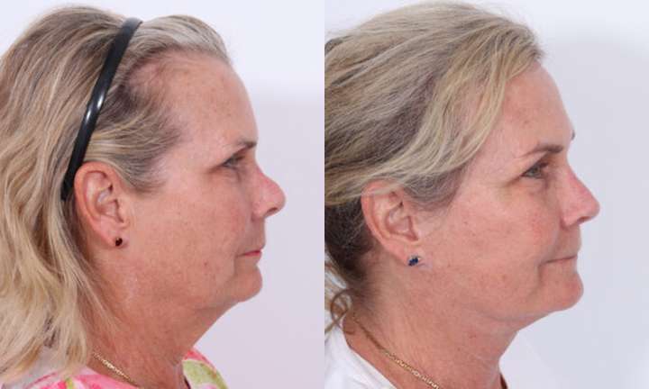 Rhinoplasty Before and After Photo by Dr. Cleveland in West Palm Beach Florida