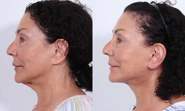 Facelift Before and After Photo by Dr. Cleveland in West Palm Beach Florida