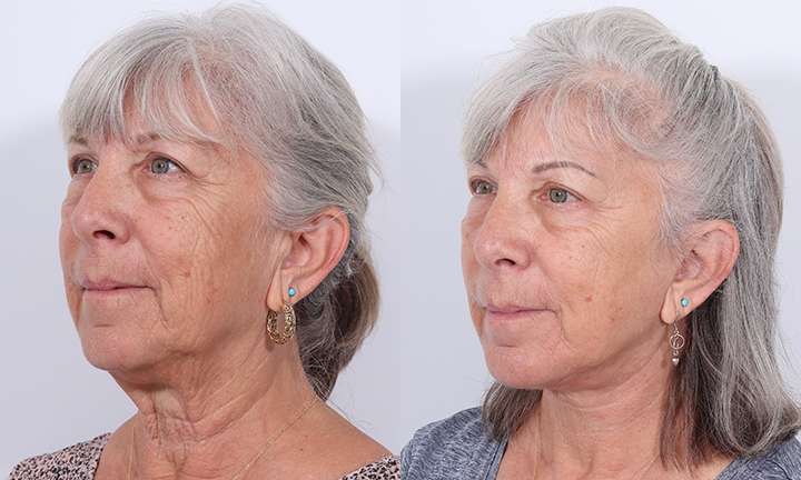 Facelift Before and After Photo by Dr. Cleveland in West Palm Beach Florida