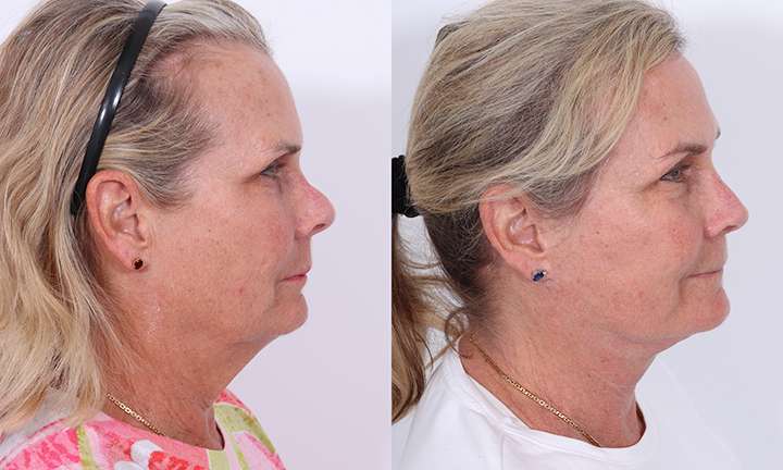 Facelift Before and After Photo by Dr. Cleveland in West Palm Beach Florida