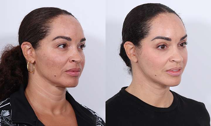Facelift Before and After Photo by Dr. Cleveland in West Palm Beach Florida