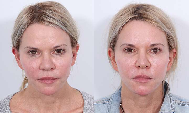 Blepharoplasty Before and After Photo by Dr. Cleveland in West Palm Beach Florida
