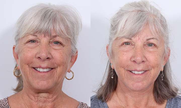 Blepharoplasty Before and After Photo by Dr. Cleveland in West Palm Beach Florida