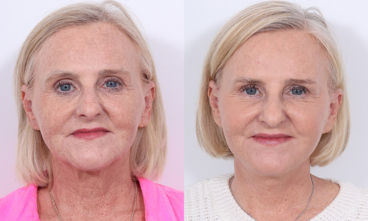 Facelift Before and After Photo by Dr. Cleveland in West Palm Beach Florida