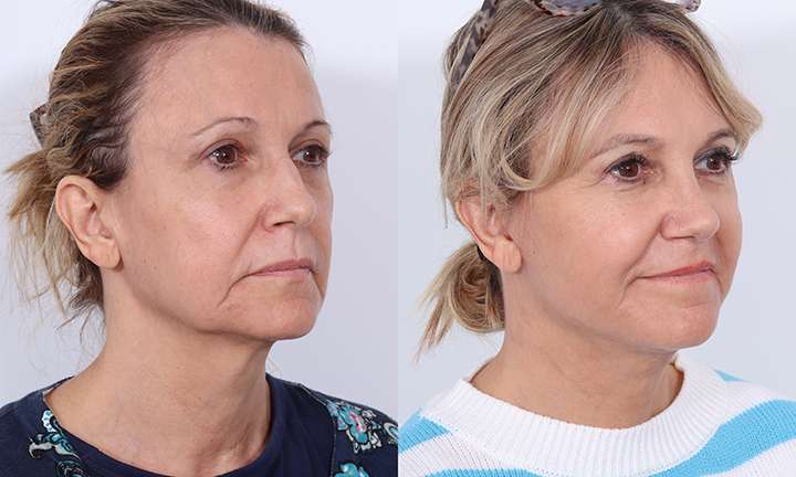 Facelift Before and After Photo by Dr. Cleveland in West Palm Beach Florida