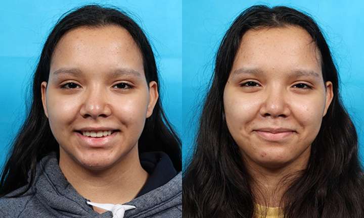 Rhinoplasty Before and After Photo by Dr. Cleveland in West Palm Beach Florida