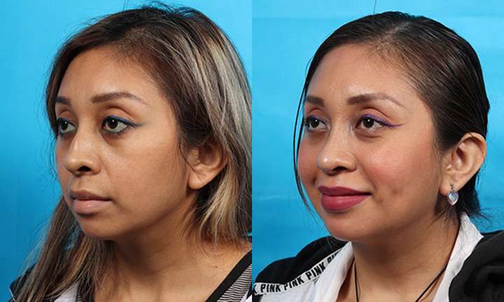 Rhinoplasty Before and After Photo by Dr. Cleveland in West Palm Beach Florida