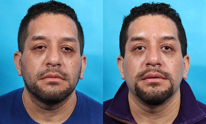 Blepharoplasty Before and After Photo by Dr. Cleveland in West Palm Beach Florida